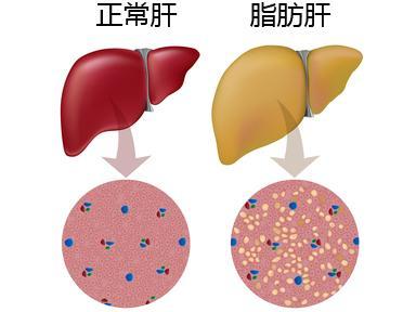 解析脂肪肝:肥胖饮酒是元凶,坚持锻炼能痊愈