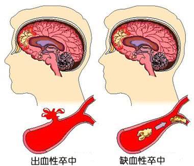 脑卒中怎么念怎么防怎么判断你可能一样都没搞清楚